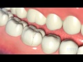 Dental Crowns: Everything You Need to Know