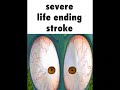 Severe Life-Ending Stroke