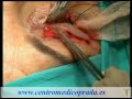 Centro Médico Prada - Blefaroplastia - Cirugía estética de los párpados