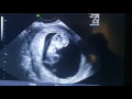 Ultrasound of Child Movement at 10 weeks