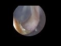 Naturally soft ear wax removal with The WAXscope