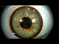 Iridology Test with Microscope