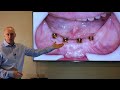 Cost of Dental Implants Lecture Nov 2021