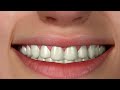 How to Get a Perfect Smile in Less than Three Visits