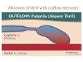 Physical Examination of Arteriovenous Fistula | ESRD NCC