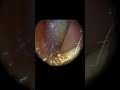 Quick softened ear wax removal using WAXscope