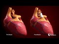 Medical Animation: Norwood Operation | Cincinnati Children's