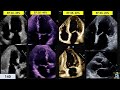 Visual Guessing Ejection Fraction- Technique & practice