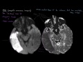 Diagnosing strokes with imaging CT, MRI, and Angiography | NCLEX-RN | Khan Academy