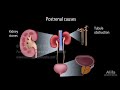 Acute Kidney Injury, a.k.a. Acute Renal Failure, Animation