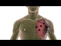 Chest Pain - Trigger Points